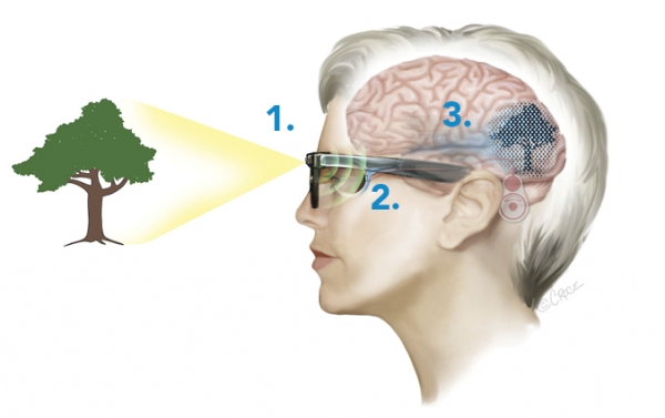 BVT가 시력 회복을 위해 개발한 BIONIC EYE 기술 ①카메라가 이미지를 캡처하고 무선으로 데이터를 전송한다. ②삽입물이 망막 세포를 자극한다. ③망막에서 뇌로 보내지는 전기 신호